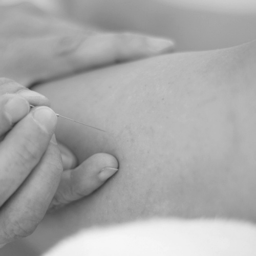 Ötzi und die Akupunktur